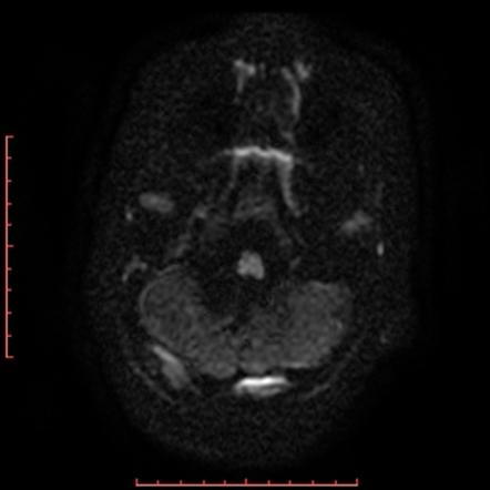 Hydrancephaly within the vertebrobasilar territory | Image ...