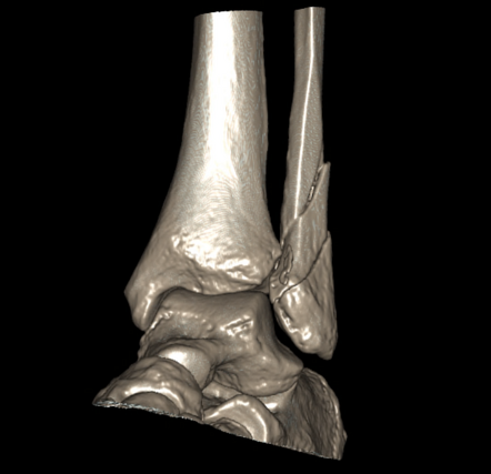 Weber Classification Of Ankle Fractures | Radiology Reference Article ...