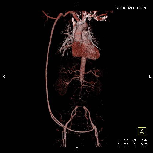 Aortectomy and axillary-bifemoral bypass | Image | Radiopaedia.org