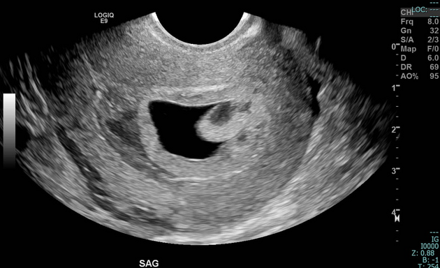 chorionic villi ultrasound