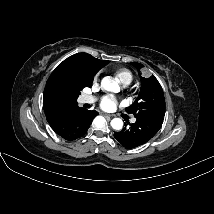 Lung metastatic melanoma | Radiology Case | Radiopaedia.org