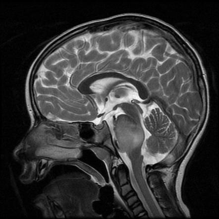 Brainstem glioma | Radiology Reference Article | Radiopaedia.org