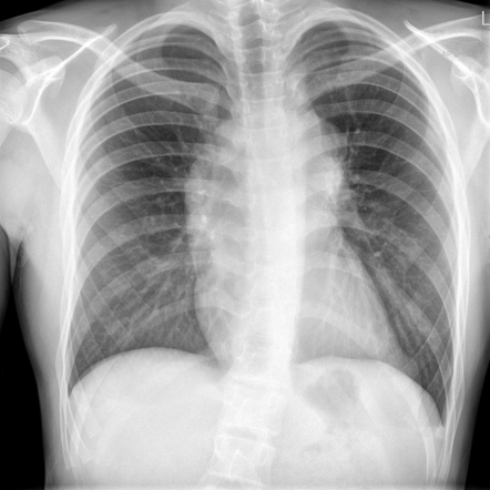 Lymphoma | Radiology Case | Radiopaedia.org