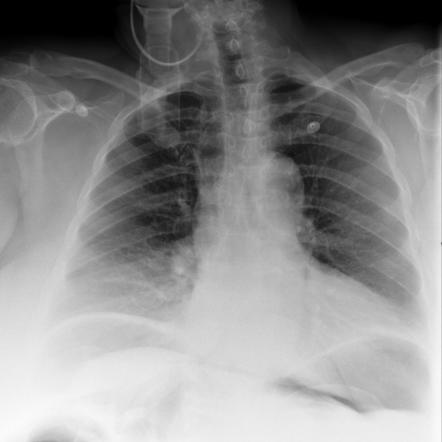 Viewing playlist: Pneumoperitoneum | Radiopaedia.org