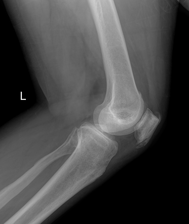 Enthesopathy | Radiology Reference Article | Radiopaedia.org