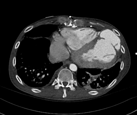 Left ventricular pseudoaneurysm | Radiology Case | Radiopaedia.org