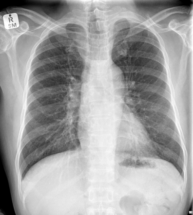 Companion shadows | Radiology Reference Article | Radiopaedia.org