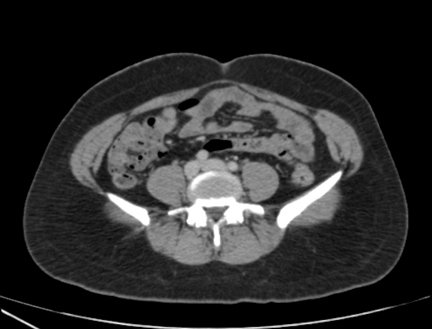 Normal CT abdomen and pelvis - female | Radiology Case 