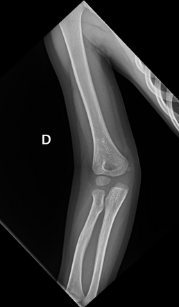 Medial Epicondyle Fracture Radiology Case Radiopaedia Org