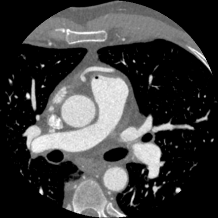 Prepulmonic left coronary artery | Radiology Case | Radiopaedia.org