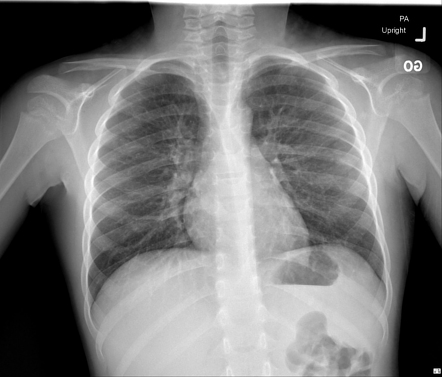 Normal chest radiograph - pediatric | Radiology Case | Radiopaedia.org