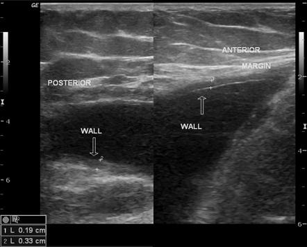 Morel-Lavallée lesion - ultrasound | Image | Radiopaedia.org