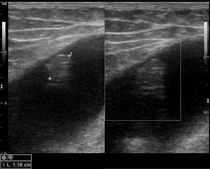 MorelLavallée lesion ultrasound Image