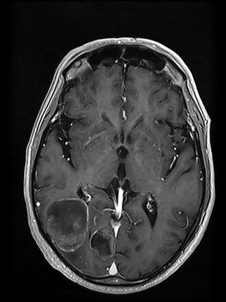 Brain Metastases From Lung Cancer | Radiology Case | Radiopaedia.org