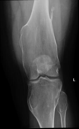 Hereditary multiple exostoses | Radiology Case | Radiopaedia.org