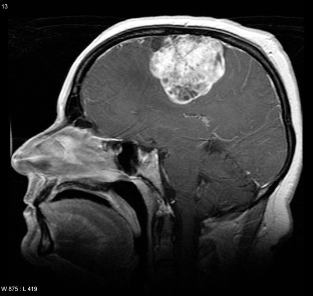 Mixed microcystic and angiomatous meningioma | Radiology Case 