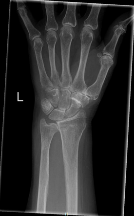 Radial fracture | Radiology Case | Radiopaedia.org