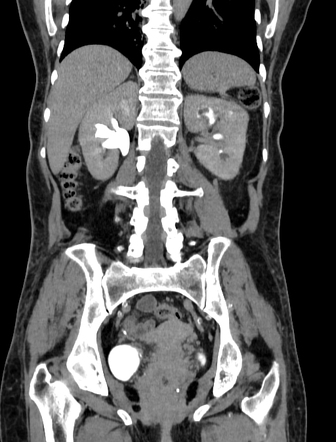 Renal papillary necrosis | Radiology Case | Radiopaedia.org