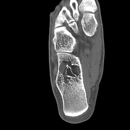 Calcaneal intraosseous lipoma | Image | Radiopaedia.org