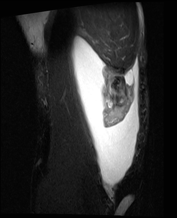 Complete Distal Biceps Tendon Rupture Image