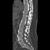 Ankylosing Spondylitis Radiology Reference Article Radiopaedia Org