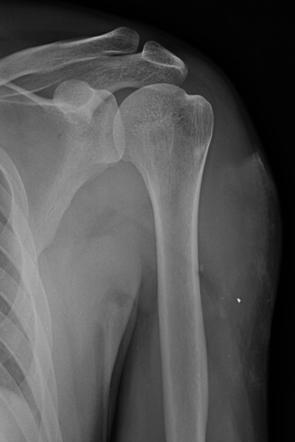 Foreign body in arm | Radiology Case | Radiopaedia.org