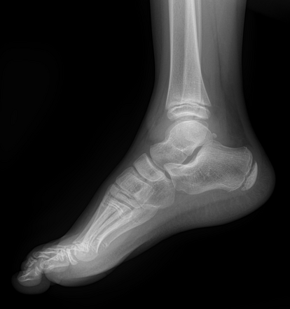 Distal fibula fracture - Salter-Harris type II | Radiology Case ...