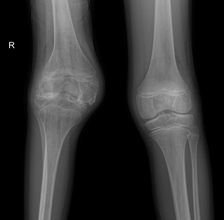 Haemophilic arthropathy | Radiology Case | Radiopaedia.org