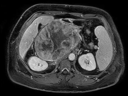 Undifferentiated Pleomorphic Sarcoma Of The Retroperitoneum Radiology Reference Article