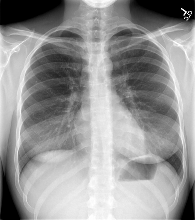 Normal chest radiograph - pediatric | Radiology Case | Radiopaedia.org