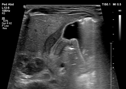 Hypertrophic pyloric stenosis | Radiology Case | Radiopaedia.org