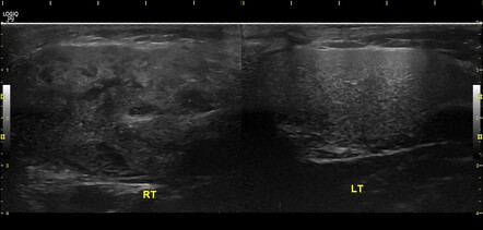 Sialolithiasis with sialadenitis - parotid gland | Radiology Case ...