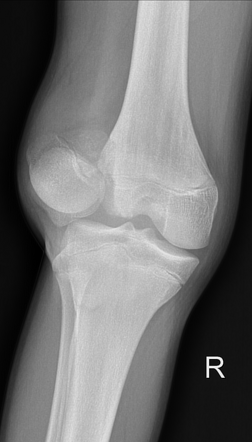 Lateral patella dislocation with femoral condyle fracture | Radiology ...