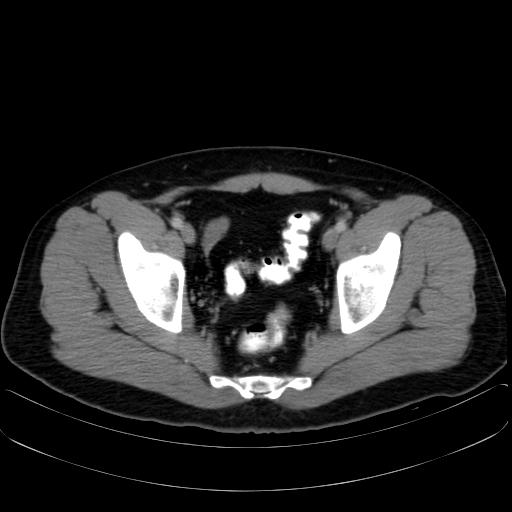 Undescended Testicle Surgery