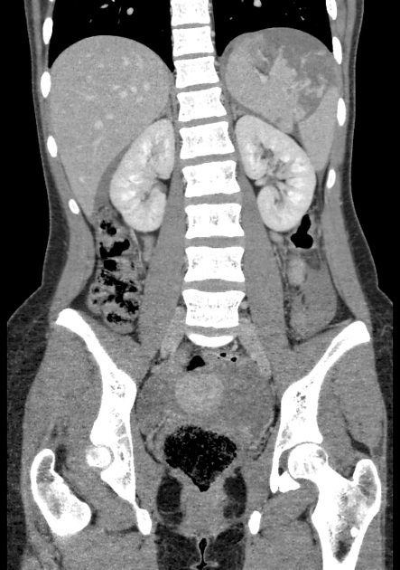 Splenic Trauma Radiology Reference Article