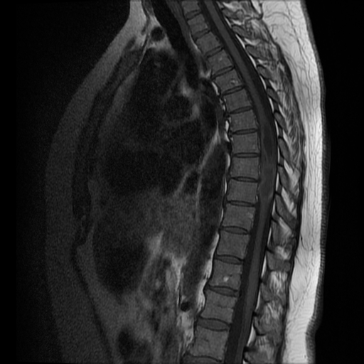 Ependymoma (thoracic) | Image | Radiopaedia.org