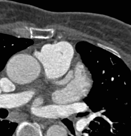 Anomalous right coronary artery from the pulmonary artery | Radiology ...