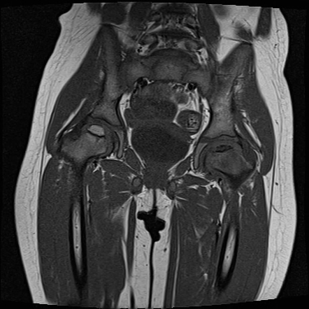 Perthes disease | Radiology Case | Radiopaedia.org