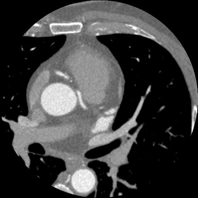 Interarterial course of the left coronary artery | Radiology Reference ...