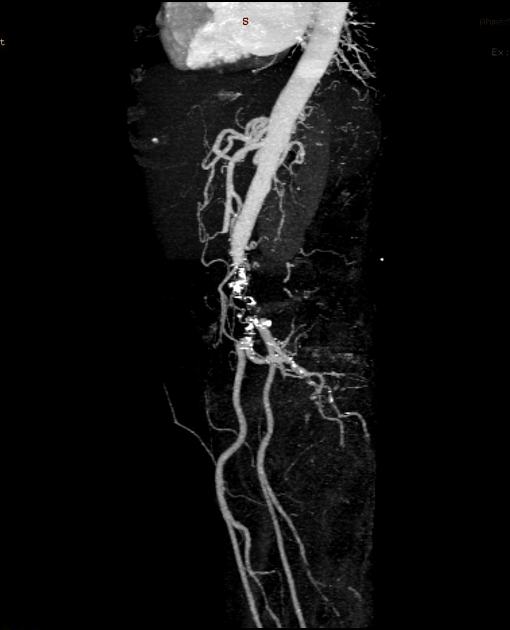 Aortoiliac occlusive disease Radiology Reference Article