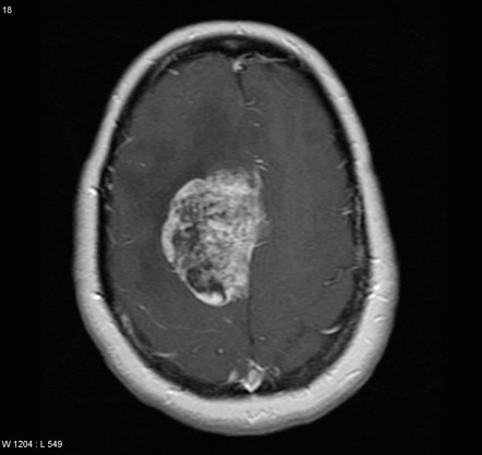 Meningeal hemangiopericytoma | Radiology Reference Article ...