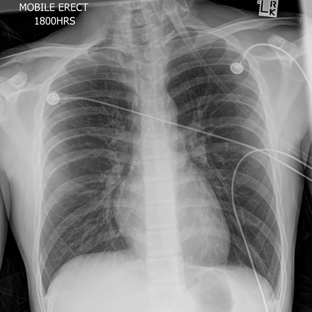 Pneumomediastinum | Radiology Case | Radiopaedia.org