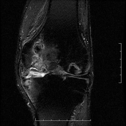 Avascular necrosis and osteochondral fracture of the knee | Radiology ...