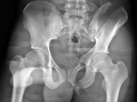 Lateral compression pelvic ring fracture | Radiology Case | Radiopaedia.org