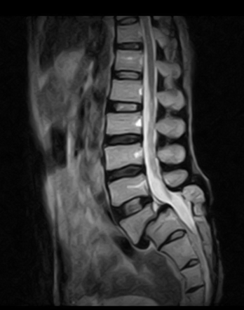 Grade II anterolisthesis of L5 over S1 | Radiology Case | Radiopaedia.org