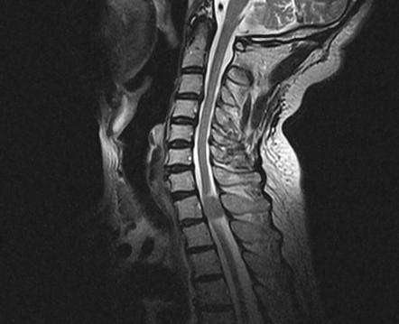 Viewing playlist: 663 6 - intraspinal lesions | Radiopaedia.org