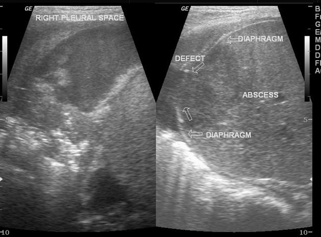 Hepatic Abscess Radiology Reference Article