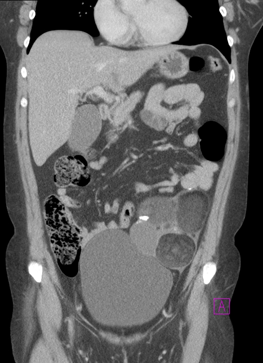 Mature (cystic) ovarian teratoma | Image | Radiopaedia.org