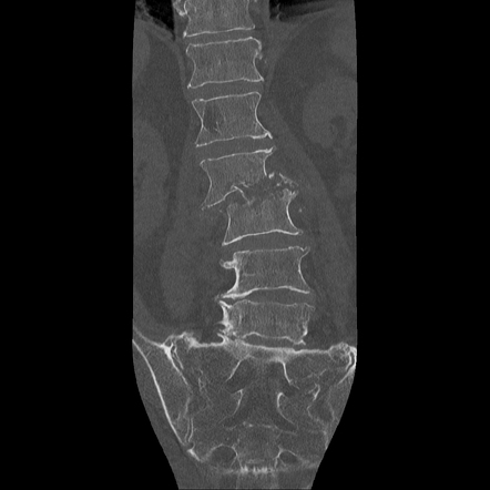 Spondylodiscitis | Radiology Reference Article | Radiopaedia.org