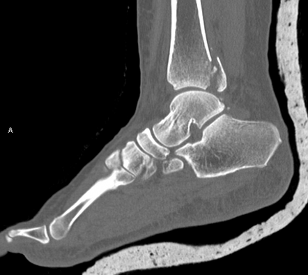 Posterior malleolus fracture | Radiology Reference Article ...